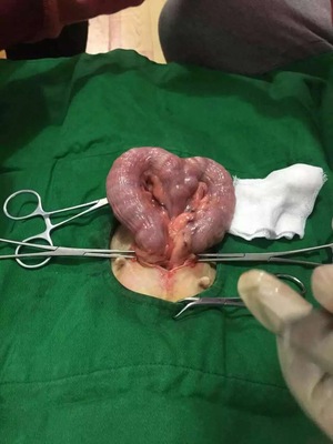 腰椎管狭窄手术后效果如何?手术风险多大?术后多长时间可以走路?
