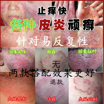 肛周瘙痒图片
