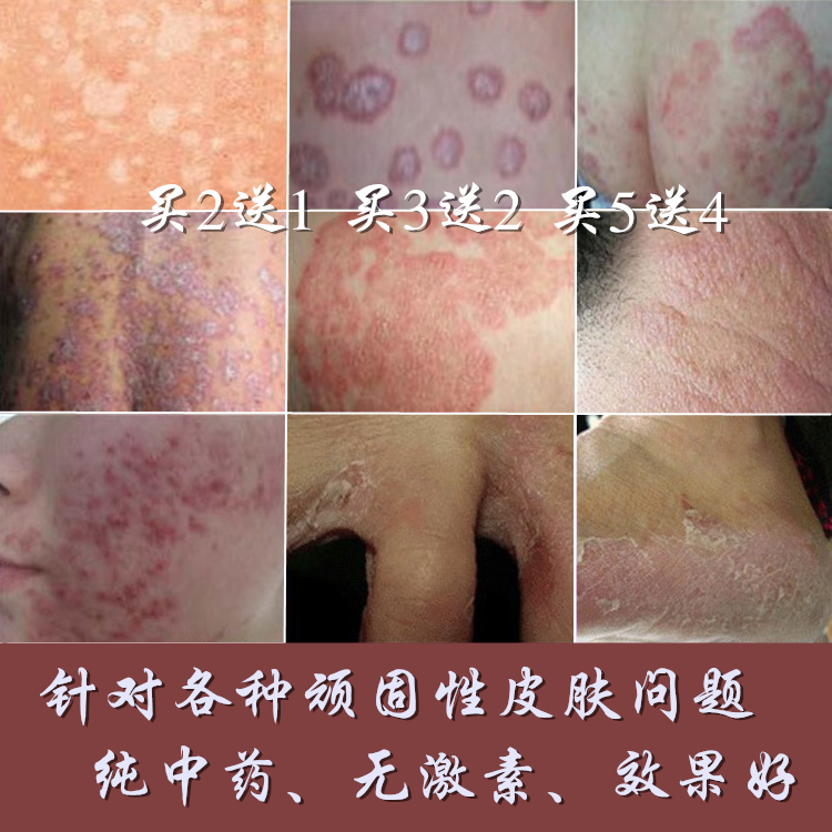 牛皮银屑藓藓癣外用皮肤止痒膏软乳膏特效阴囊股肛门瘙痒脚气药膏
