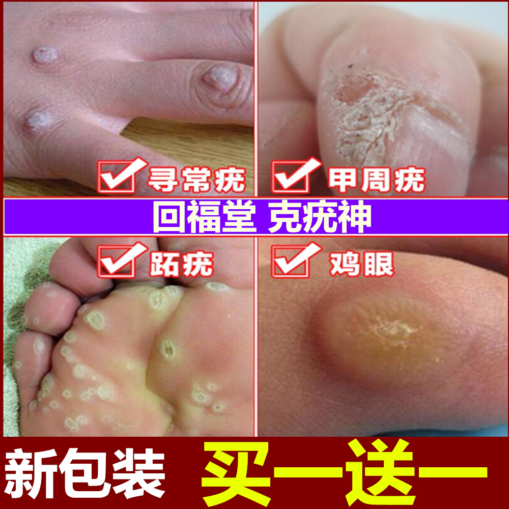 瘊疣净鱼鳞痣特效去除甲周疣肉刺脚丁老茧病毒疣鸡眼膏净刺瘊子