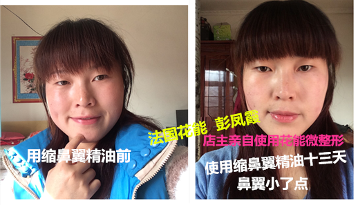 蒜头鼻小酒窝 小紧实改善鼻翼肥大蒜头鼻 蒜头鼻整形后前4天恢复情况汇报 蒜头鼻的救星爱我蒜头鼻矫正手术 蒜头鼻 蒜头鼻矫正 娃娃脸蒜头鼻 蒜头鼻天后王菲已经开始显老了 我16岁蒜头鼻 爱我蒜头鼻矫正 厚嘴唇有蒜头鼻的吗有婴肥的吗.郁闷啊 鼻子:蒜头鼻 美鼻当家蒜头鼻彻底变身 蒜头鼻面相详解 mm示范缩小蒜头鼻 鼻子:蒜头鼻 蒜头鼻的男人容易花心?