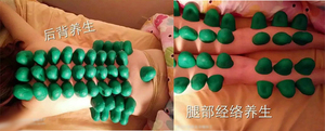 磁灸减肥罐磁疗