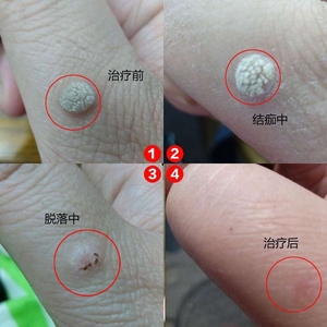 跖疣膏特效去除
