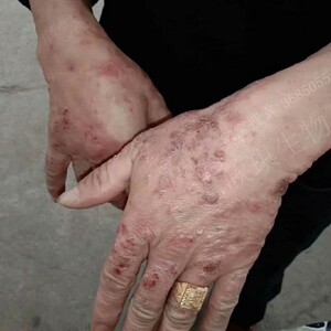 手癣膏真菌感染脚藓股鲜根部治疗牛皮癣止痒湿疹去根抑菌股藓药膏