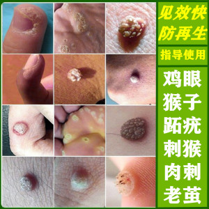特效去除肉瘊子猴子贴刺瘊猴子手上脚上身体瘊子贴疣候瘊子膏
