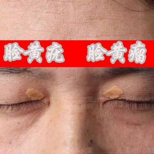 过年发货 色橙色睑黄瘤疣去除睑黄疣睑黄瘤斑膏圆眼部黄睑疣康膏