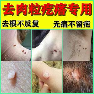 去瘊子脖子小肉粒疙瘩肉瘤皮赘人体乳头瘤病毒肉刺宝宝消除肉丁丁