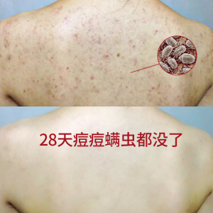 除螨皂硫磺皂去螨虫香皂男女脸部背部后背袪痘痘洗脸沐浴全身可用