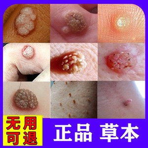 腋下瘊子皮赘去除膏祛猴子肉瘤脖子上长的小肉粒疙瘩凸痣肉刺神器
