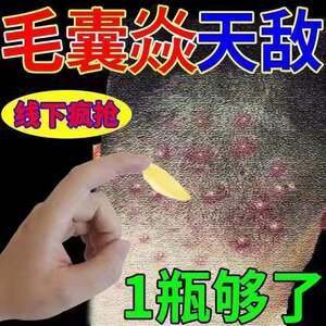头皮癣药膏