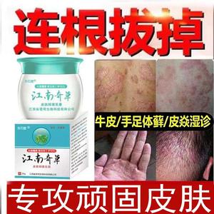 灰黄霉素人用灰黄霉素软膏甲癣抗真菌灰黄霉素头癣治头癣药膏外用