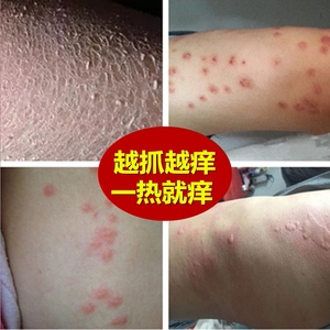 全身上痒冬季皮肤瘙痒大小腿干燥起皮后背起红疙瘩外用止痒抑菌膏