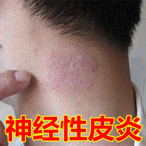 2022治疗神经性皮炎去外用根膏除止痒外用药膏皮肤日光性脂溢性