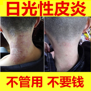 日光性皮炎去外用除药膏根的紫外线过敏神经性脂溢性李一氏治治疗