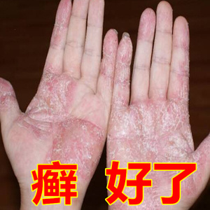 774人付款淘宝李氏百草膏治牛皮銀屑癣药膏手脚开裂脱皮抑菌止痒皮肤