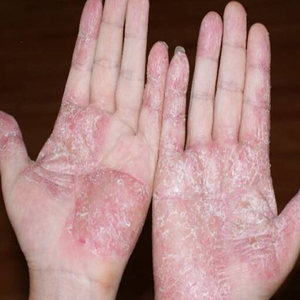 鹅掌风干裂脱皮真菌感染手癣膏手藓药膏手痒水泡治专手部李一氏