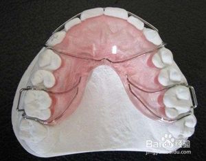 钢丝保持器 哈雷保持器 传统保持器 哈雷hawley