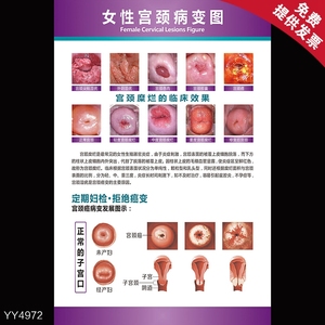 女性健康宣传海报 女性宫颈病变示意挂图 妇科科室装饰布置墙贴画