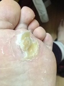 去除手足脚趾老茧净手指厚茧脚底胼胝关节硬皮脚垫贴鸡眼死皮硬茧