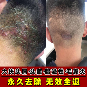 头皮屑癣去头癣头皮炎银屑癣毛囊炎脂溢性皮炎洗发水专用药膏头部