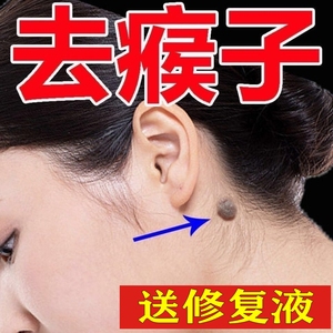 点去除瘊子猴子脖子上长的小肉粒疙瘩刺瘊子肉刺药膏面部头部颈部