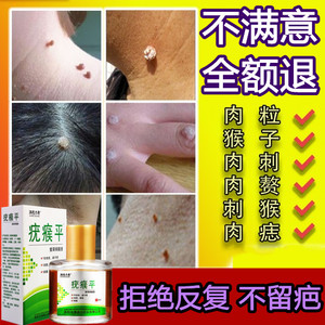 刺猴去除正品治瘊子药手足部肉刺膏脚底猴子肉粒疙瘩祛根贴跖疣灵