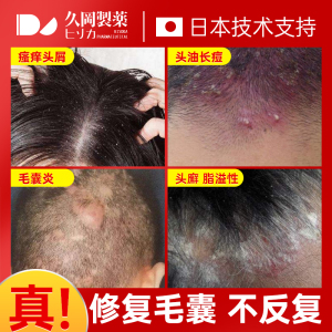 脂溢性皮炎去根除头皮癣头癣头皮屑癣头部面部外用软膏专用药膏