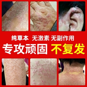 鹅掌风干裂脱皮治痘痘的药膏鲜手脱皮真菌感染真菌感染手脱皮手上