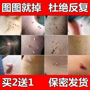 身上长小颗粒药脖子腋肉下皮赘肉疙瘩小肉丁丁肉揪揪线瘊软纤维瘤