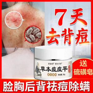 背上脸部手臂长痘痘后背祛除螨虫叮咬儿童人用药膏祛痘瘙痒止痒膏
