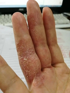 手痒水泡脱皮水泡型季节性反复手藓手足干裂手脚痒起小水泡止痒膏