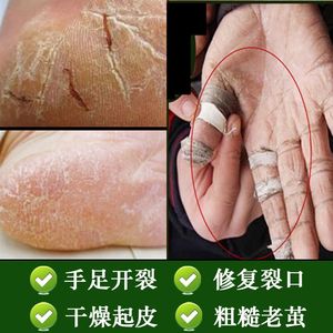 龟裂膏手足龟裂