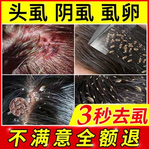 80谈定啊淘宝虱子药去除儿童头虱子灭虱卵百部酊洗发水小女孩头发虱