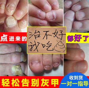 灰指甲专用药灰甲净日本