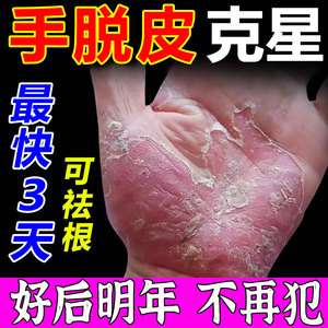 治疗手脱皮药膏真菌感染季节性手水泡湿疹过敏蜕皮神器男女用手痒