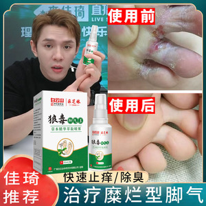 脚气喷剂治脚臭脚汗