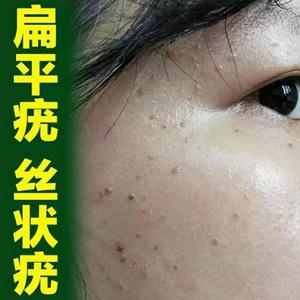 扁平疣去除膏面部专用药神器祛疣瘊子丝状疣脖子颈部小肉粒疙瘩