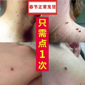 点脖子上小肉粒去除膏头部面脸上痦子刺瘊子肉痣凸痣神器腋下疙瘩