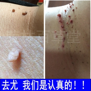 【瘊疣平软膏】瘊疣平软膏品牌,价格 - 阿里巴巴