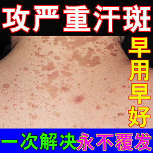 汗斑专用药斑藓红斑克星汗斑净香露花斑喷剂脖子后背汗斑去除神器