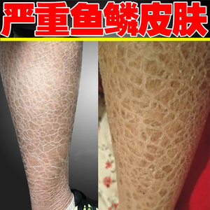 冬季腿上皮肤干燥蛇皮肤鱼鳞小腿部手臂克星病止痒脱皮滋润补水治