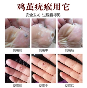 急眼贴脚疣贴去老茧手部鸡眼膏药治疗脚疣刺猴去除正品止尤净足疣