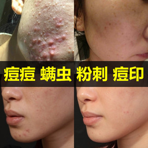 萃芙兰祛痘膏淡化消痘印痘疤坑闭口粉刺尚美祛痘修复羽雪颜雷曼