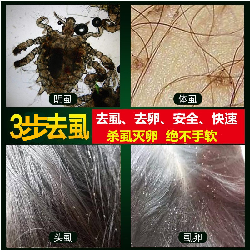 净虱露除头虱