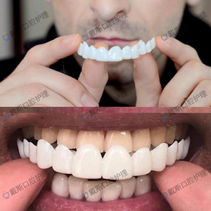 上下牙套吃饭防塞牙没牙亮肆老人专用假牙套可吃饭神器咀嚼仿真.