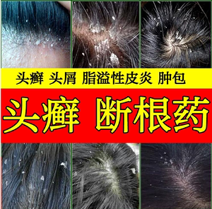 头癣治疗头部牛皮藓癣头皮屑真菌感染洗发水毛囊炎银屑病外用药膏