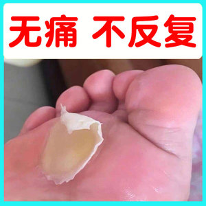 去脚底根长脚垫神器老茧子专用胼胝贴脚钉祛除膏手上硬死皮软化剂