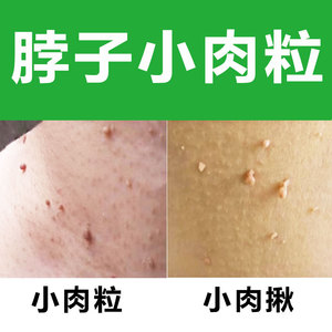 去肉瘤肉痣小肉揪神器脖子上长小肉粒丝状疣腋下痦子点黑痣皮赘膏