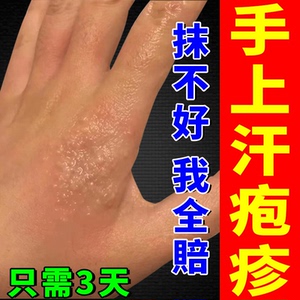汗疱疹专用汗状疱疹手干裂手痒脱皮起小水泡真菌感染止痒抑菌药膏