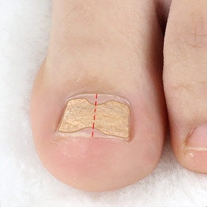 指甲内嵌矫正器嵌甲专用甲贴家用甲沟护理炎贴脚趾甲往肉里长神器